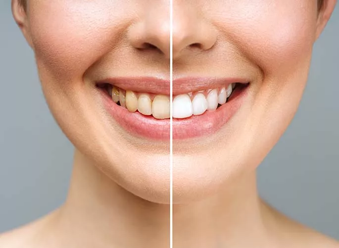 Teeth Whitening in markham